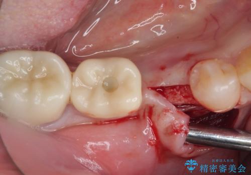 割れてしまった奥歯 インプラント治療の治療前
