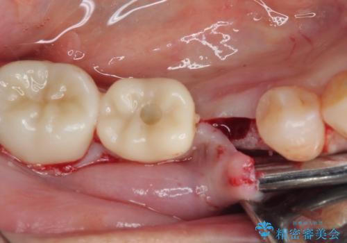 割れてしまった奥歯 インプラント治療の治療中
