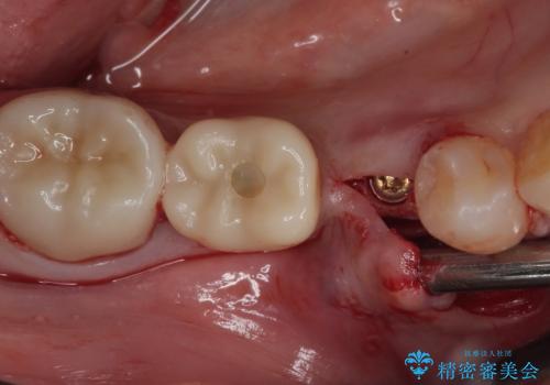 割れてしまった奥歯 インプラント治療の治療中
