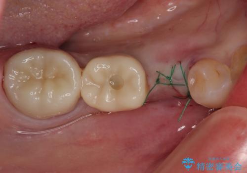 割れてしまった奥歯 インプラント治療の治療後