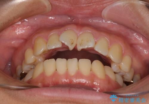 欠損と口元の突出感 ワイヤー装置での抜歯矯正の治療前