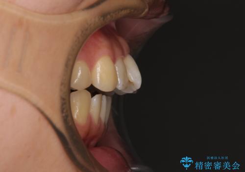 欠損と口元の突出感 ワイヤー装置での抜歯矯正の治療前