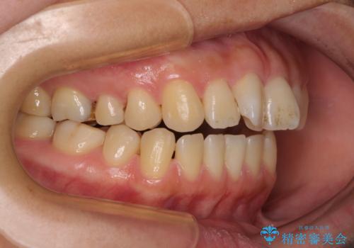 欠損と口元の突出感 ワイヤー装置での抜歯矯正の治療前