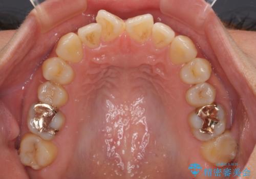 欠損と口元の突出感 ワイヤー装置での抜歯矯正の治療前