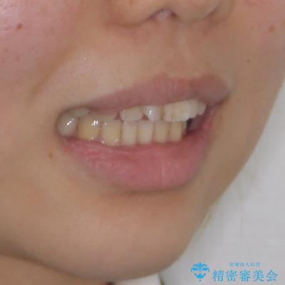 欠損と口元の突出感 ワイヤー装置での抜歯矯正の治療前(顔貌)