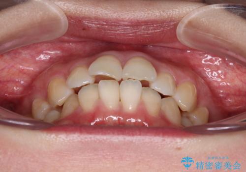 インビザライン・モデレートを用いて気になる後戻りを矯正治療の治療前