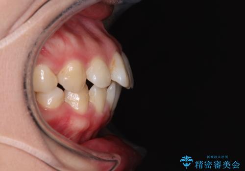 インビザライン・モデレートを用いて気になる後戻りを矯正治療の治療前