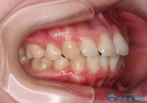 インビザライン・モデレートを用いて気になる後戻りを矯正治療の治療前