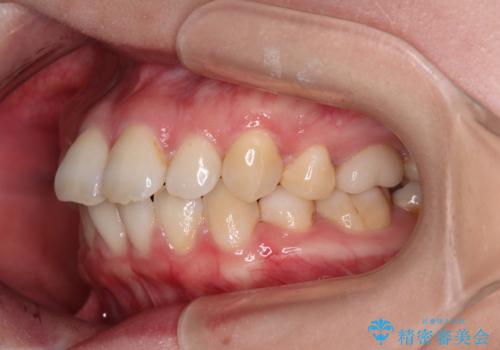 インビザライン・モデレートを用いて気になる後戻りを矯正治療の治療前