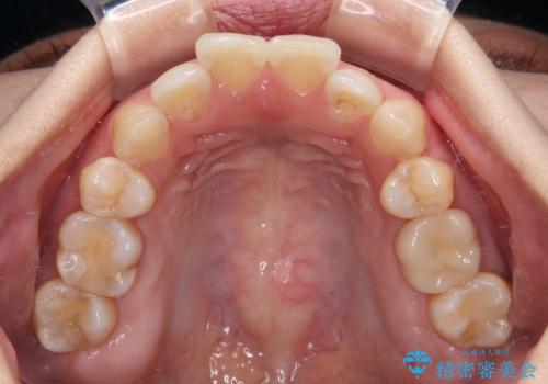 インビザライン・モデレートを用いて気になる後戻りを矯正治療の治療前