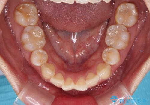 インビザライン・モデレートを用いて気になる後戻りを矯正治療の治療前