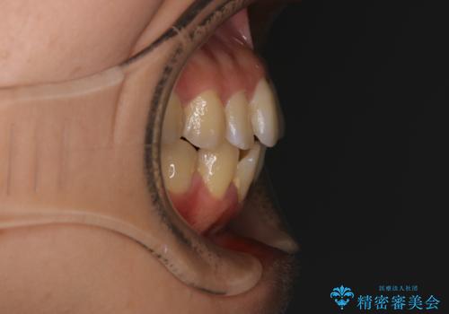 前歯を後ろに下げたい ワイヤー矯正(クリア装置)の治療前