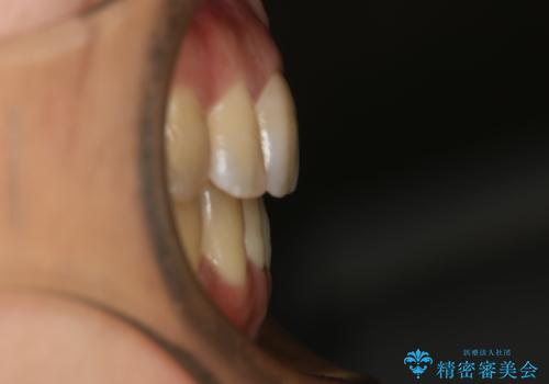 前歯を後ろに下げたい　ワイヤー矯正(クリア装置)の治療後