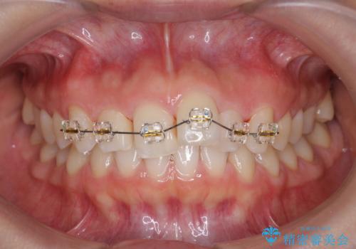 出っ歯に見える前歯の改善 部分ワイヤーとマウスピース矯正の治療前