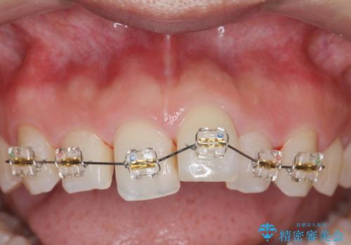 出っ歯に見える前歯の改善 部分ワイヤーとマウスピース矯正の治療前