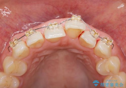 出っ歯に見える前歯の改善 部分ワイヤーとマウスピース矯正の治療前