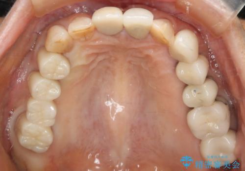 ツギハギの被せ物をキレイなセラミックへの症例 治療後