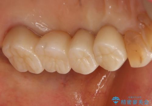 ツギハギの被せ物をキレイなセラミックへの治療後