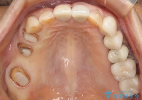 ツギハギの被せ物をキレイなセラミックへの治療中