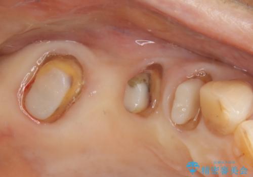 ツギハギの被せ物をキレイなセラミックへの治療中
