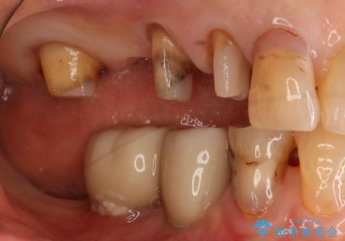 ツギハギの被せ物をキレイなセラミックへの治療中
