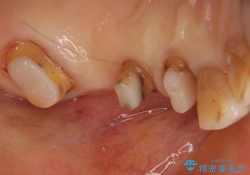 ツギハギの被せ物をキレイなセラミックへの治療中