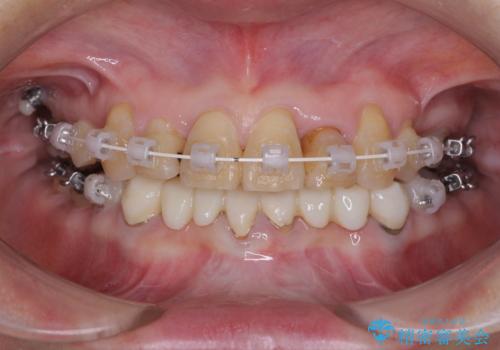 外れるブリッジと気になる八重歯 総合歯科治療で美しい口元にの治療中