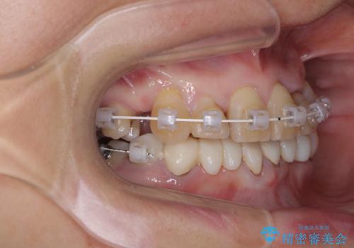 外れるブリッジと気になる八重歯 総合歯科治療で美しい口元にの治療中