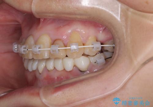 外れるブリッジと気になる八重歯 総合歯科治療で美しい口元にの治療中