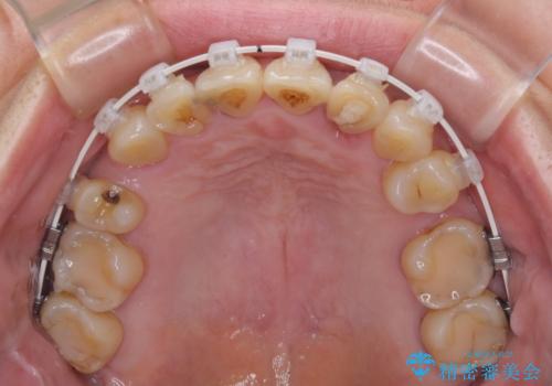外れるブリッジと気になる八重歯 総合歯科治療で美しい口元にの治療中