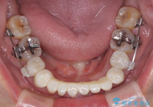 外れるブリッジと気になる八重歯 総合歯科治療で美しい口元にの治療中