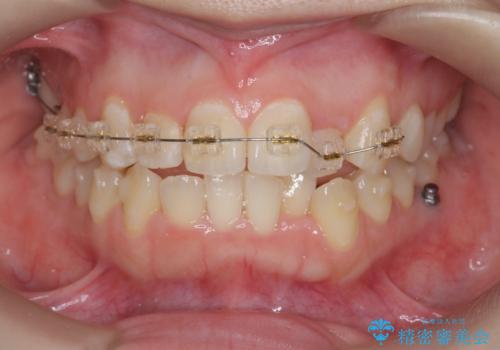 前歯のズレ・がたつき・すれ違いの矯正治療の治療前