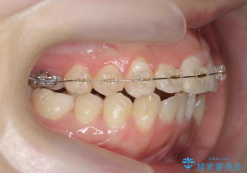前歯のズレ・がたつき・すれ違いの矯正治療の治療前