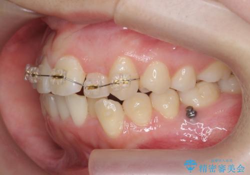 前歯のズレ・がたつき・すれ違いの矯正治療の治療前