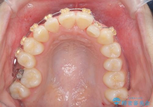 前歯のズレ・がたつき・すれ違いの矯正治療の治療前