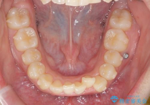 前歯のズレ・がたつき・すれ違いの矯正治療の治療前