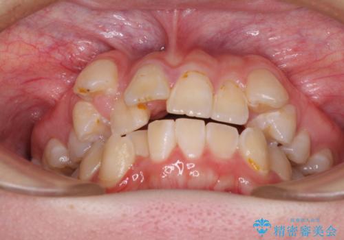 転位歯や埋伏歯などの難易度の高い抜歯矯正治療の治療前