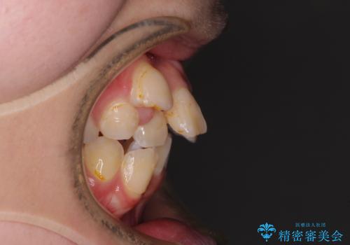 転位歯や埋伏歯などの難易度の高い抜歯矯正治療の治療前