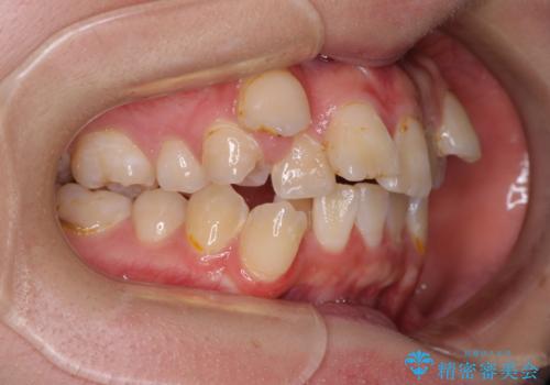 転位歯や埋伏歯などの難易度の高い抜歯矯正治療の治療前