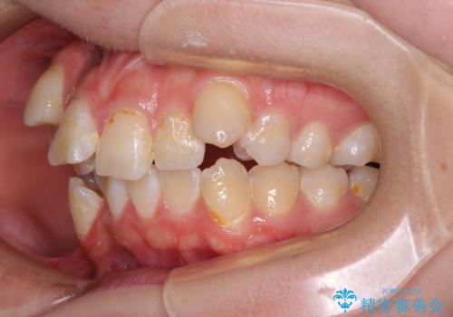 転位歯や埋伏歯などの難易度の高い抜歯矯正治療の治療前