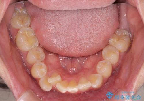 転位歯や埋伏歯などの難易度の高い抜歯矯正治療の治療前