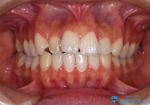 奥歯の咬み合わせのズレと前歯の突出感 変則的な抜歯矯正の症例 治療前