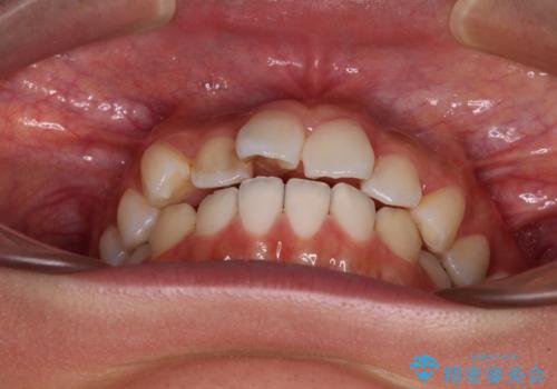 奥歯の咬み合わせのズレと前歯の突出感 変則的な抜歯矯正の治療前