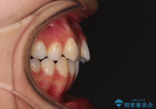 奥歯の咬み合わせのズレと前歯の突出感 変則的な抜歯矯正の治療前