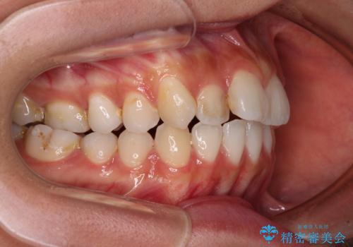 奥歯の咬み合わせのズレと前歯の突出感 変則的な抜歯矯正の治療前