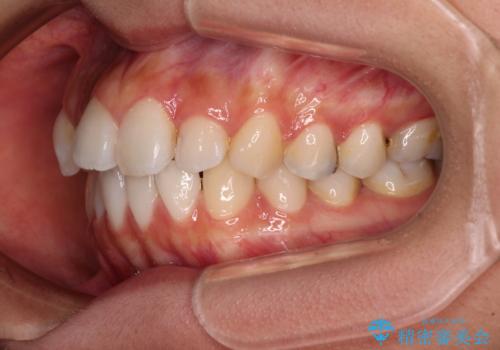 奥歯の咬み合わせのズレと前歯の突出感 変則的な抜歯矯正の治療前