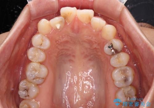 奥歯の咬み合わせのズレと前歯の突出感 変則的な抜歯矯正の治療前