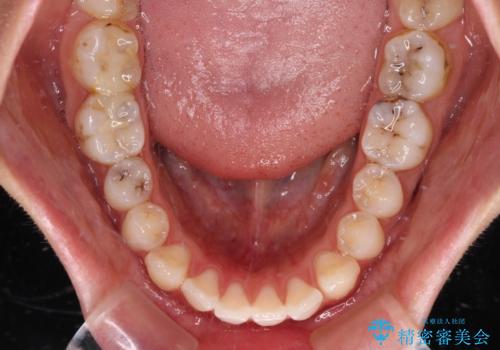 奥歯の咬み合わせのズレと前歯の突出感 変則的な抜歯矯正の治療前