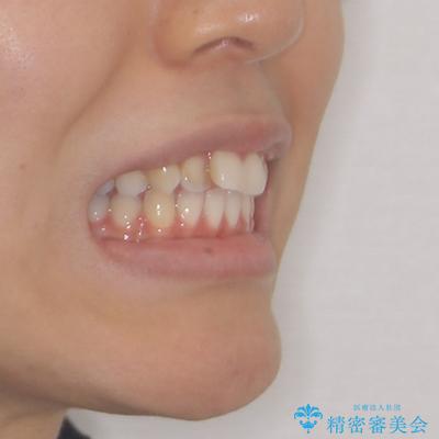 奥歯の咬み合わせのズレと前歯の突出感 変則的な抜歯矯正の治療前(顔貌)