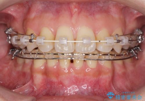 八重歯を矯正治療で治したい!の治療中